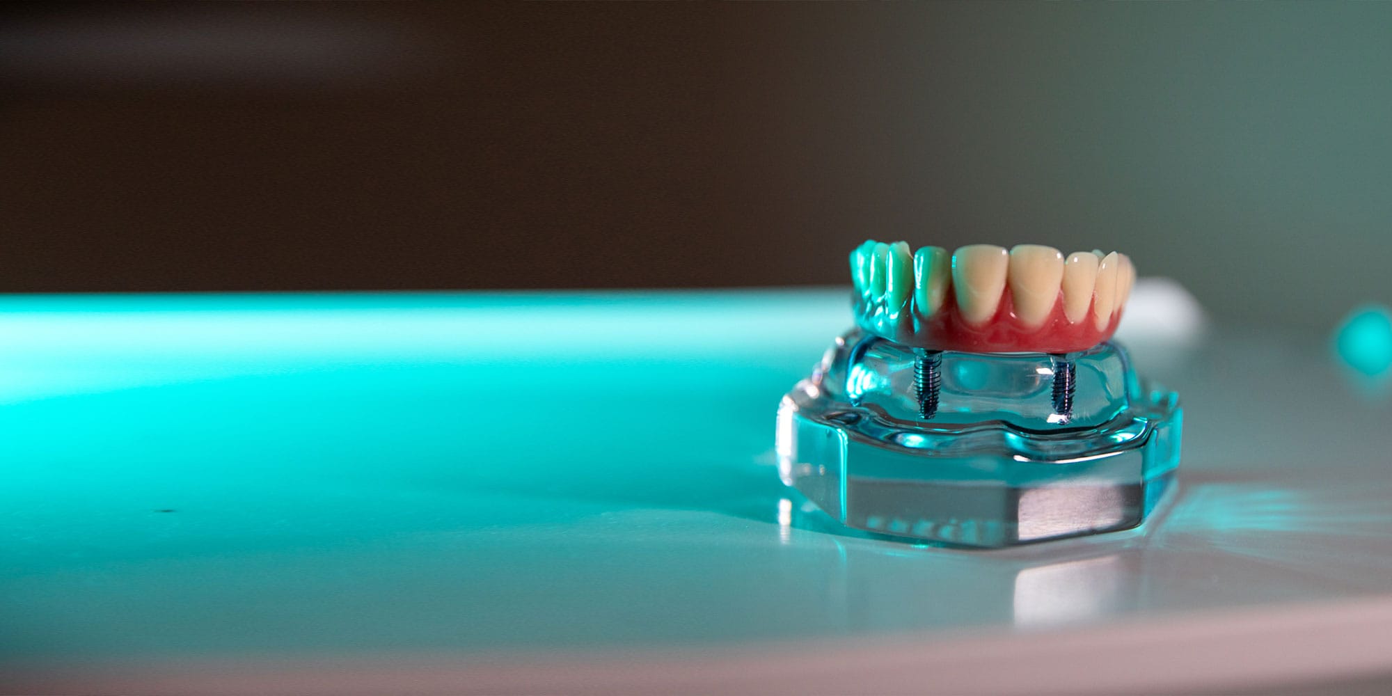 Allon4® Full Mouth Dental Implants Louisville, KY